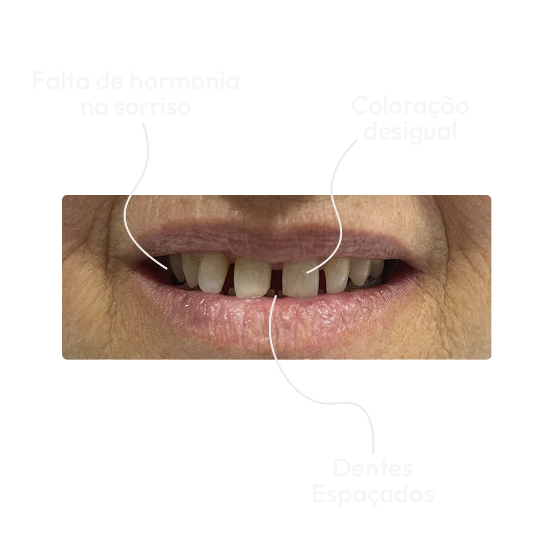 Antes